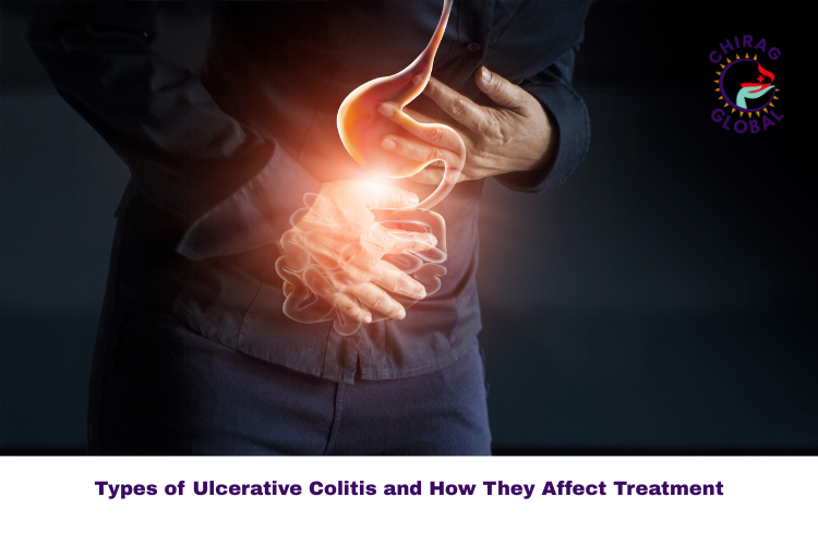 Types of Ulcerative Colitis Explained
