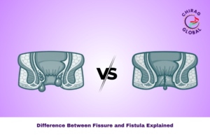 Difference Between Fissure and Fistula