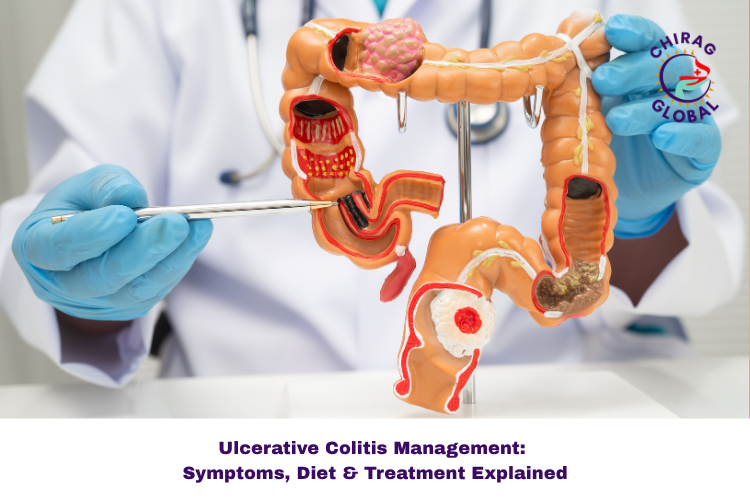 Ulcerative Colitis Management