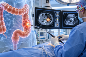 local ablative therapy for colon cancer